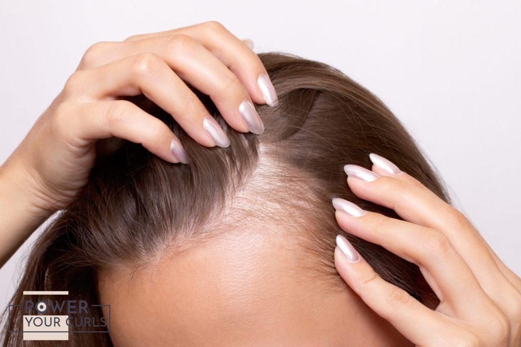 A close-up view of a human scalp showing thinning hair and a visible receding hairline.
