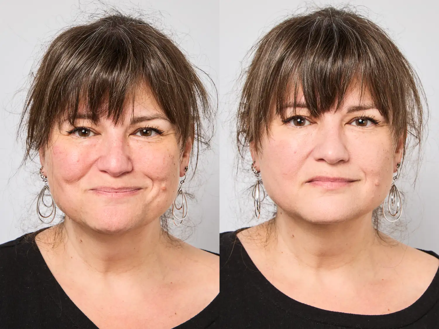 Side-by-side before and after comparison showing improved skin texture and smoothness.